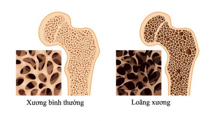 loãng xương