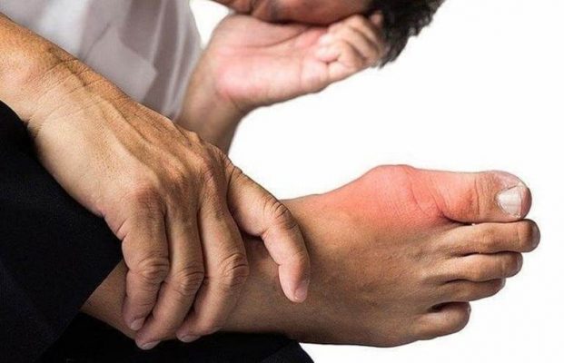 Gout là gì? Chế độ dinh dưỡng hỗ trợ người bệnh gout hiệu quả